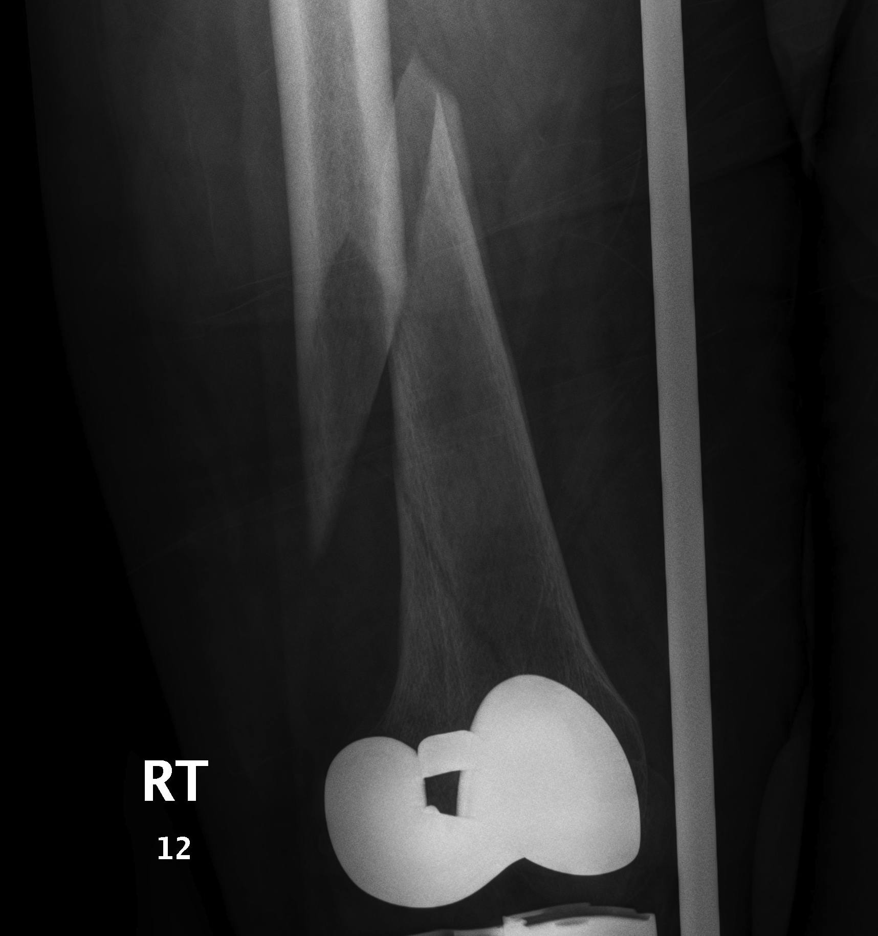 TKR Periprosthetic Fracture 2